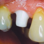 Dentist New York- Dr Lawrence Spindel implant_abuttment