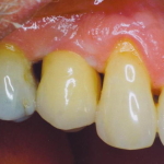 Dentist New York- Dr Lawrence Spindel implant_crown