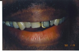 central_incisors1   