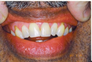 central_incisors2_001   